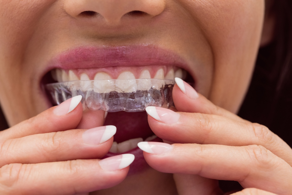 İnvisalign Şeffaf Plak Fiyatları İnvisalign Şeffaf Plak Tedavisi