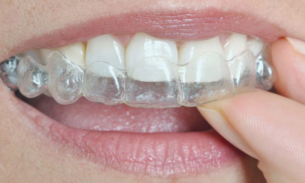 İnvisalign Tedavisi Ne Kadar Sürer? İnvisalign Tedavisi Fİyatı