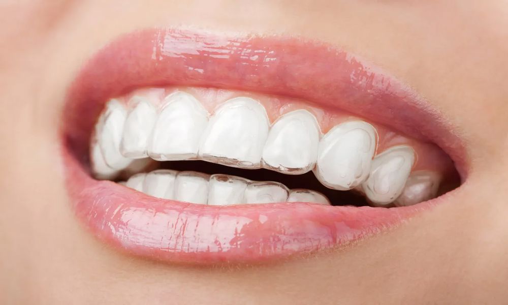 İnvisalign Tedavisi Ne Kadar Sürer? İnvisalign Tedavisi Ne Kadar Sürer