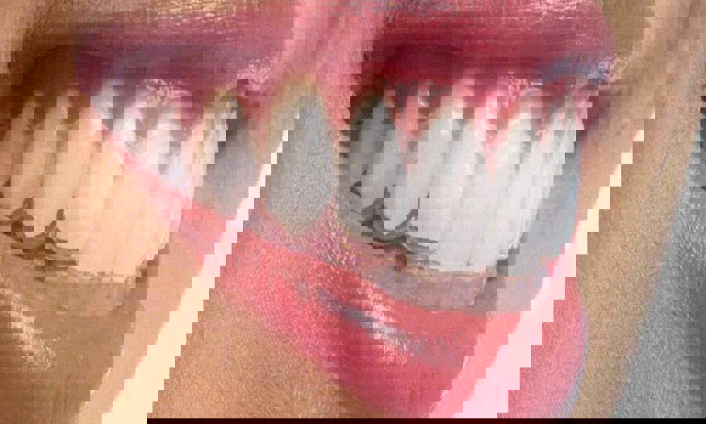 Şeffaf Plak Tedavisi Sonrası Şeffaf Plak Tedavisi Nasıl Yapılır