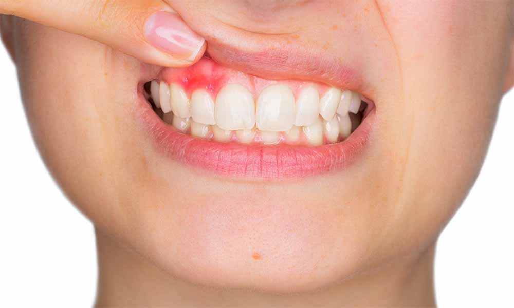 Diş Eti Seviyeleme Nedir? Diş Eti Seviyeleme Nedir?