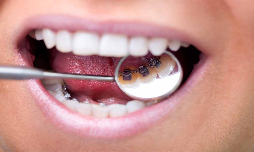 Lingual Ortodonti Nedir? Lingual Ortodonti Avantajları