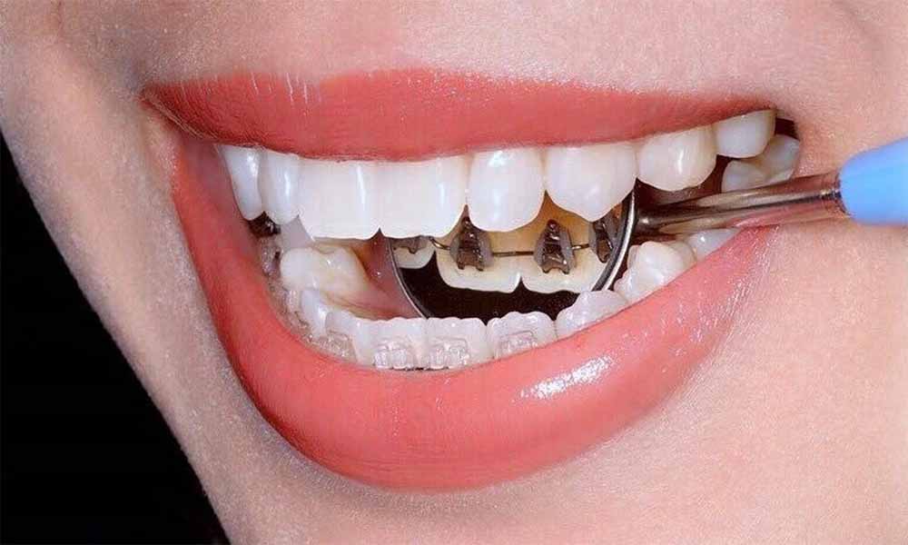 Lingual Ortodonti Nedir? Lingual Ortodonti Nedir?